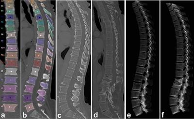 Level-Specific Volumetric BMD Threshold Values for the Prediction of Incident Vertebral Fractures Using Opportunistic QCT: A Case-Control Study